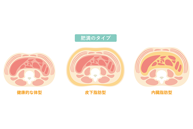 肥満のタイプは、主に皮下脂肪型と内臓脂肪型に分けられる